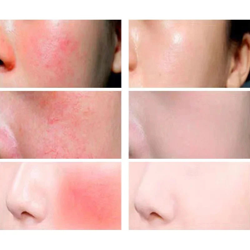 Facial Redness Repair Cream Improve Sensitive Muscles Acne Rosacea Dry&Itchy Skin Moisturizer Lotion Korean skincare products